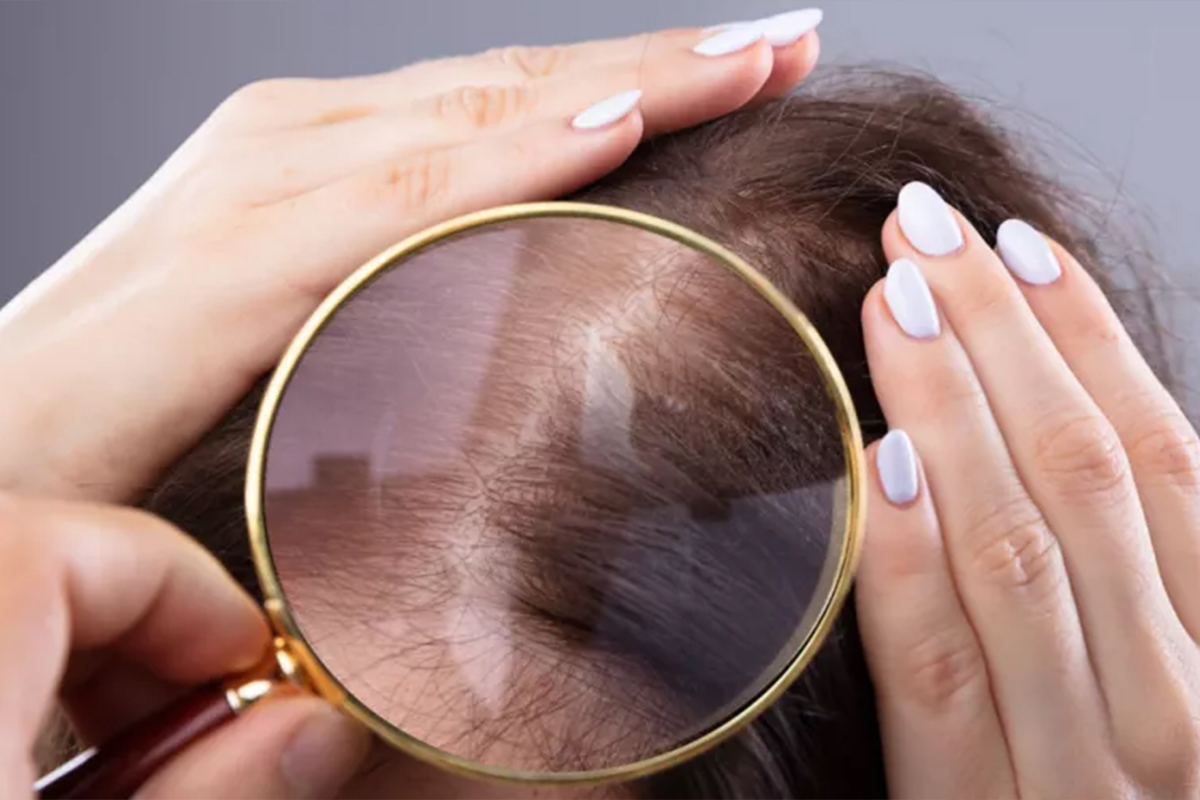 علاجات تساقط الشعر الكربي والوراثي